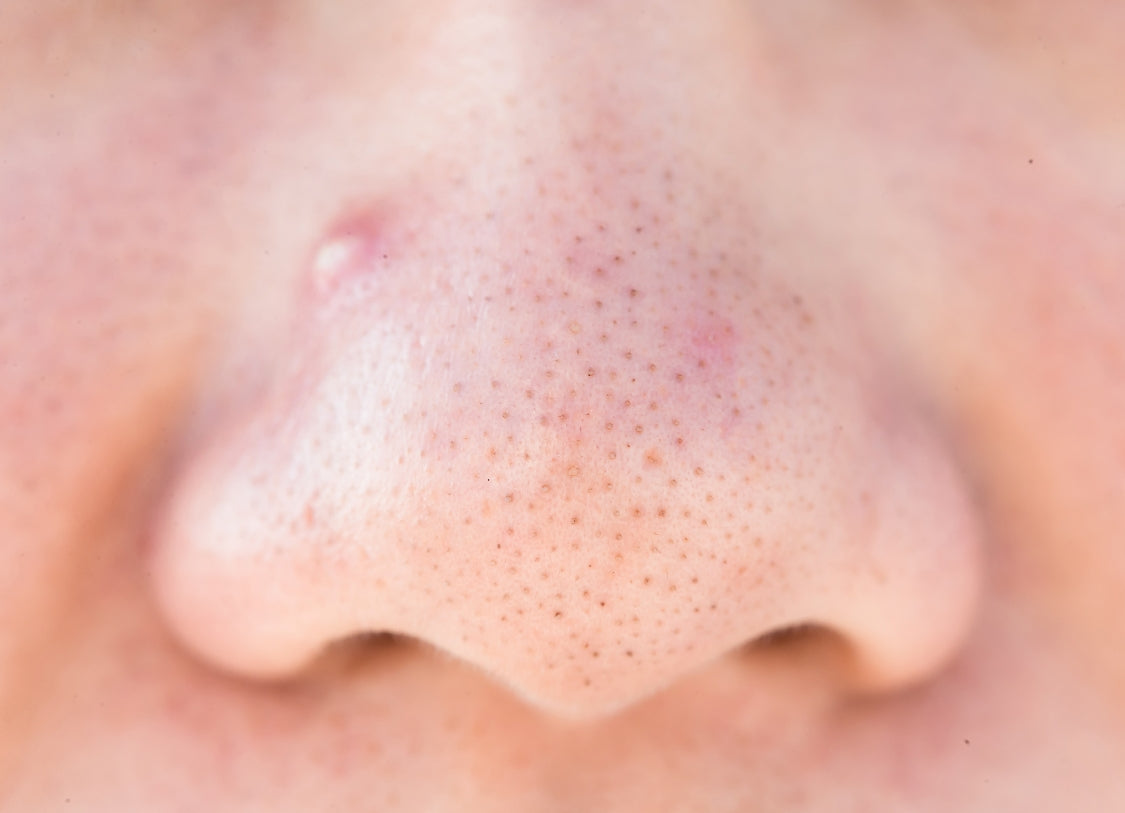 Understanding Blackheads: Causes, Prevention, and Effective Solutions