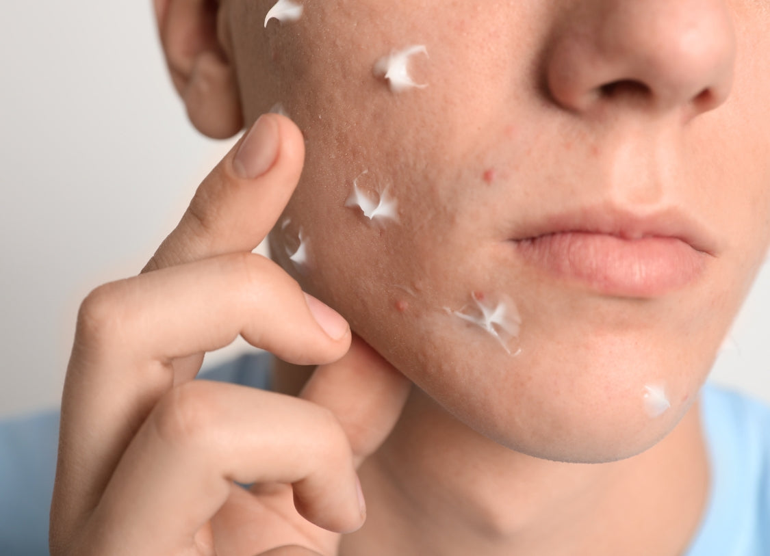 Moisturizing Acne-Prone Skin: Debunking the Myth of Oil-Free Products