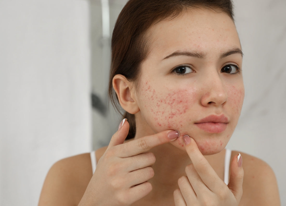 Unveiling Acne: Understanding the Causes, Types, and How Explicit Acne Control Kit Can Help